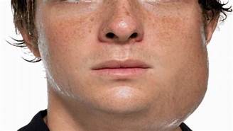 picture of man with mumps